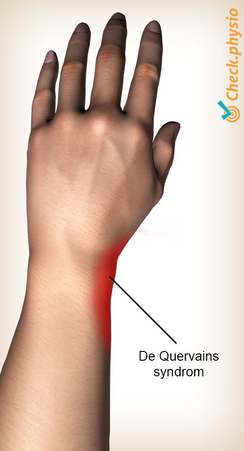 arm de Quervains sykdom lokasjon