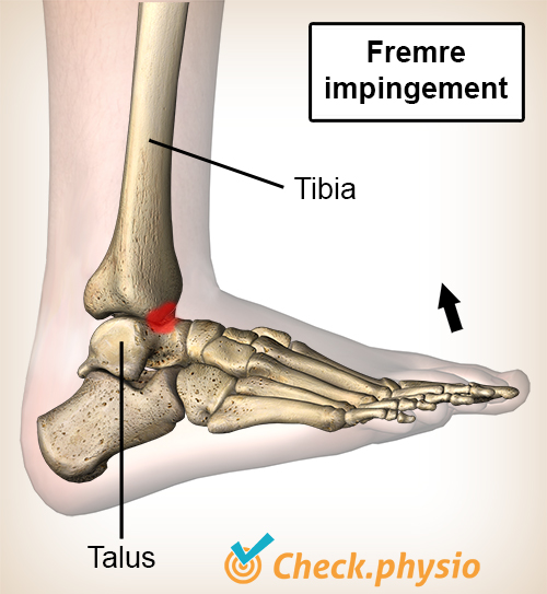 ankel fremre impingement dorsalfleksjon