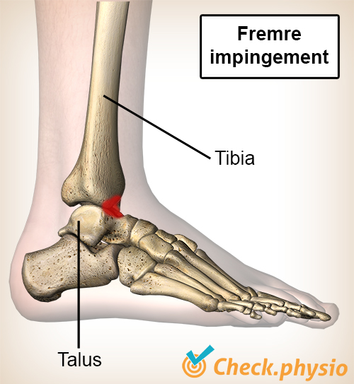 ankel fremre impingement