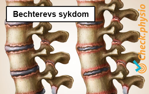rygg spesifikke korsryggsmerter bechterews sykdom spondylitt ankylopoetica