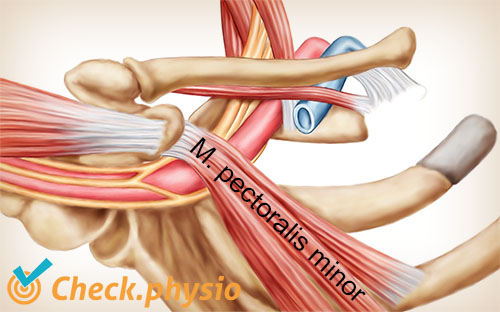 skulder arm hånd TOS thoracic outlet syndrom pectoralis minor