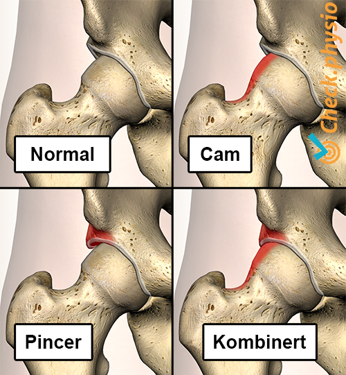 hofte impingement FAI typer