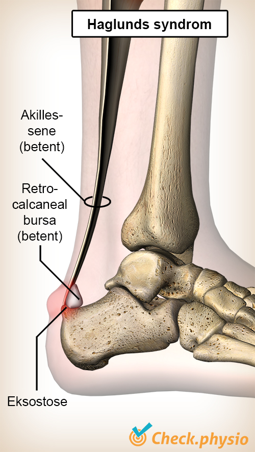 ankel haglunds syndrom akillessene bursa retrocalcanea hælben calcaneus