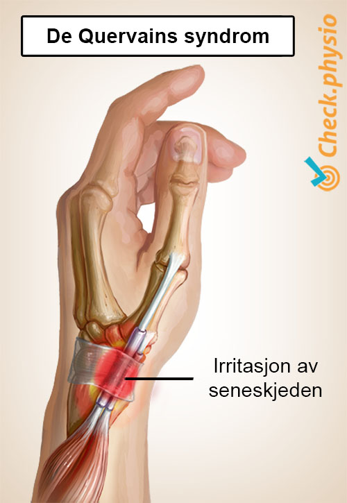 arm de Quervains sykdom