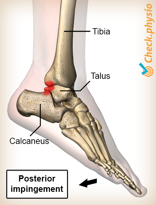 ankel bakre impingement plantarfleksjon