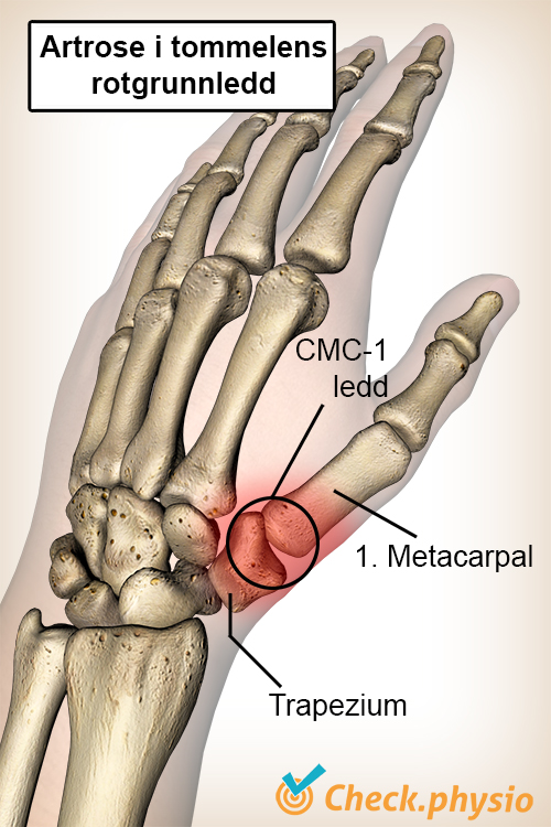 hånd tommel tommelbase artrose os trapezium mellomhåndsben metacarpal I CMC 1 ledd