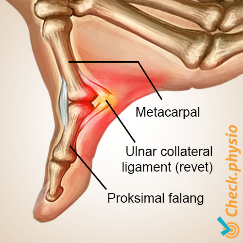 hånd skitommel anatomi ligamentum collaterale ulnare