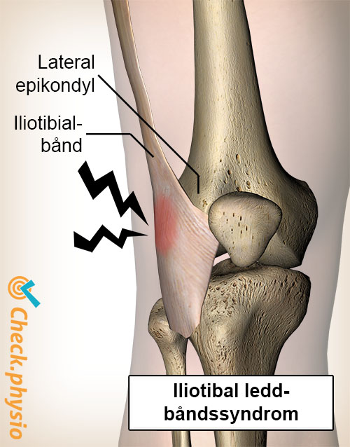 kne iliotibialleddbåndssyndrom lateral epikondyl