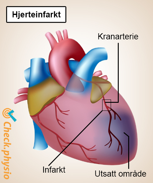 hjerte hjerteinfarkt kransarterie anatomi