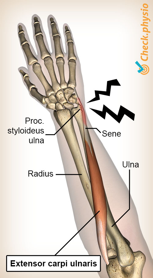 arm underarm extensor carpi ulnaris senebetennelse senelidelse