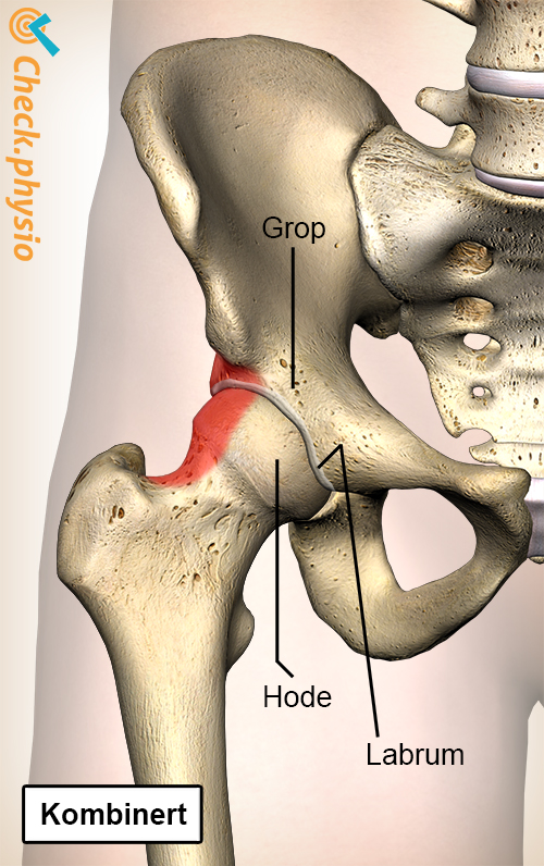 hofte femoroacetabular impingement FAI blandet kombinert