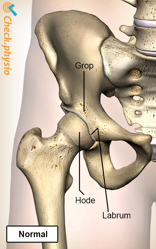 hofte femoroacetabular impingement FAI normal