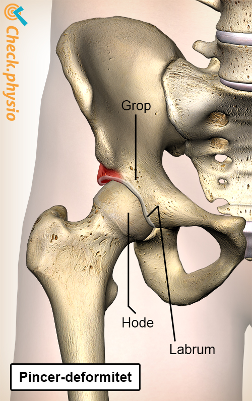 hofte femoroacetabular impingement FAI pincer