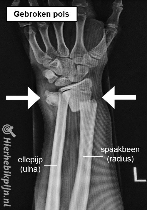 Rontgenfoto arm gebroken pols fractuur botbreuk spaakbeen ellepijp radius ulna